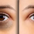 Dark Circle Treatment