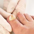 Fungal Nail Treatment