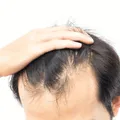 Hair Loss Treatments