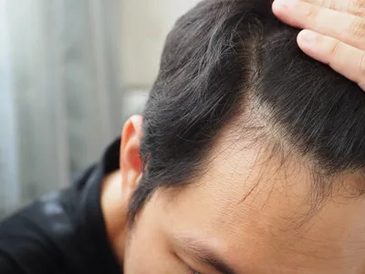 Anti-Hair Fall Treatment