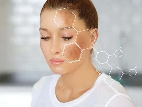 Pigmentation Treatment
