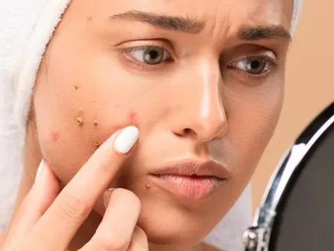 Acne & Pimple Treatment
