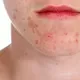 Acne Control Treatment