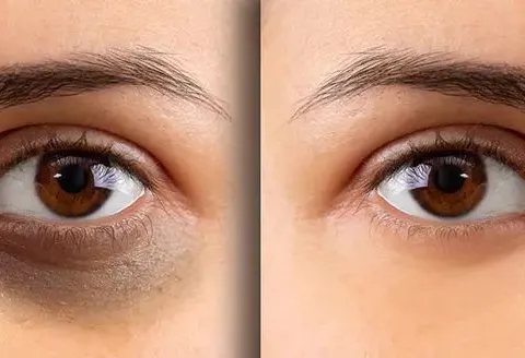 Dark Circle Treatment