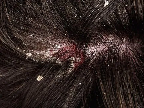 Dandruff Control Therapy