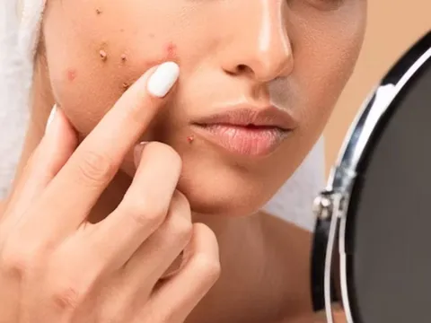Acne & Pimple Treatment