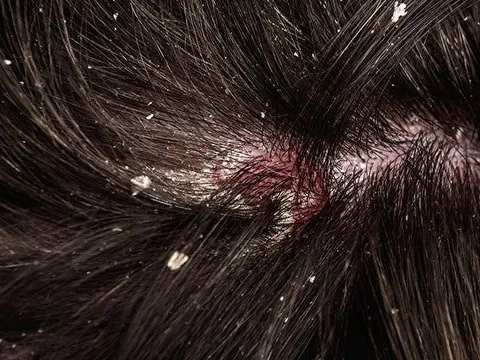 Dandruff Control Therapy
