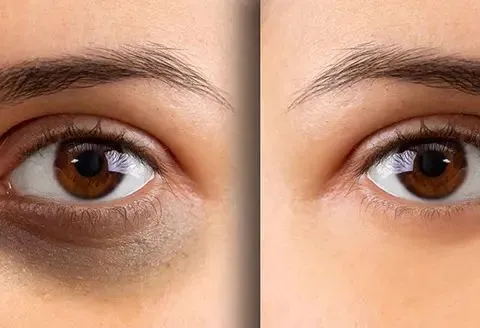 Dark Circle Treatment