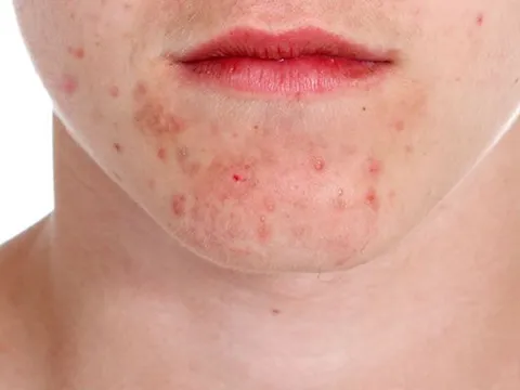 Acne Control Treatment