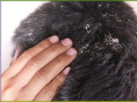 Dandruff Control Therapy