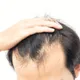 Hair Loss Treatments
