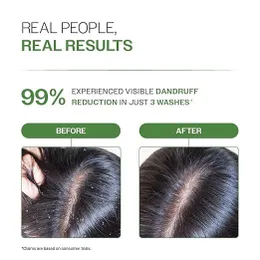 Bare Anatomy Anti Dandruff Shampoo | Reduces Up to 100% Dandruff and Strengthens Hair | Derma Approved Shampoo with Sali