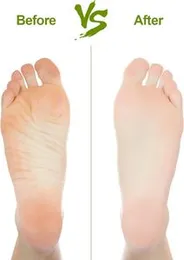 Natural Pumice Stone by Asqraqo â Lava Pedicure Tool for Feet & Hands â Callus Remover & Foot File Exfoliator to Remove Dead Skin and Rough Heels