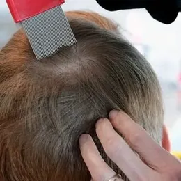 Lice Comb [Very effective for Lice and NIt Remover]