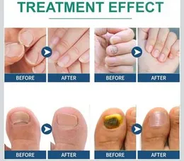 Fungal Nail Patches 16 Pieces Targeted Nail Repair,