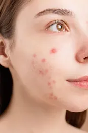 Acne & Blemish Control Facial