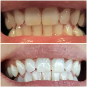 SNOW® ❄️ At Home Teeth Whitening Kit (ALL-IN-ONE)