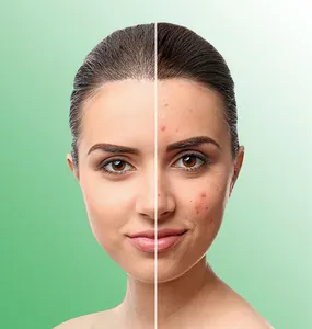 FYC Acne Prone Facial