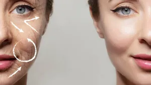 VlCC Skin-Tightening Facial