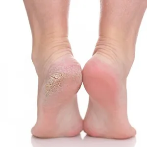 Footlogix Treatment w/Pedicure
