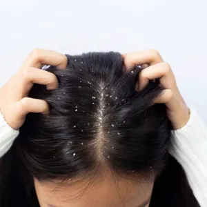 Fungal Scalp Infection Treatment
