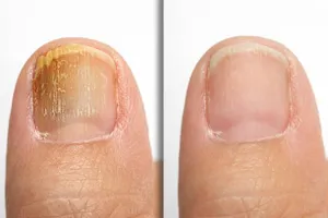 Restorative Nail Health Treatment