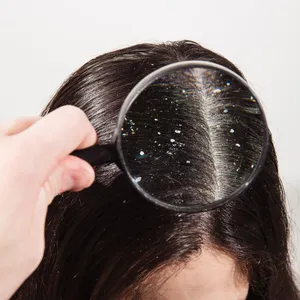 Anti-dandruff treatment