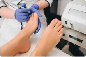 Onychomycosis Treatment